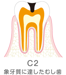 C2　象牙質に達した虫歯