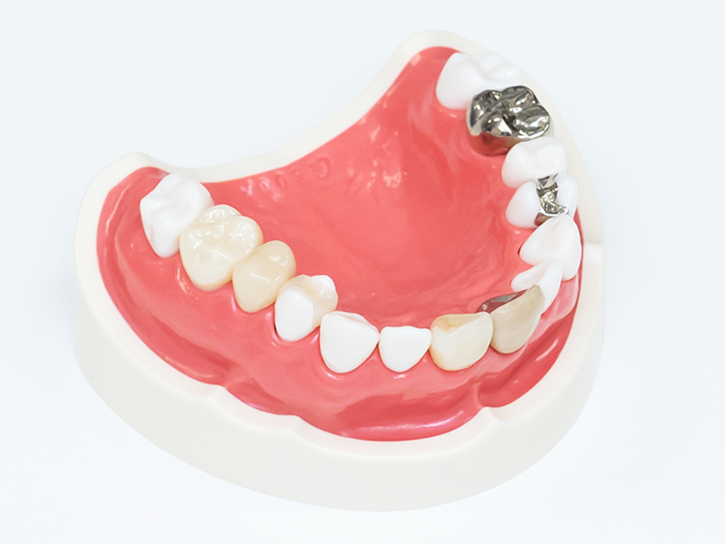 セラミック装着の様子