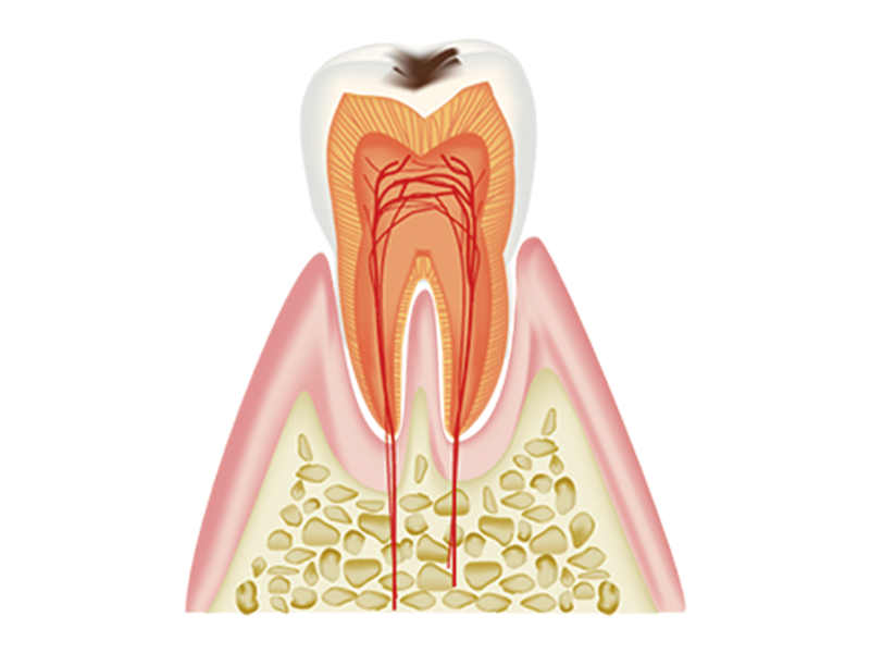 エナメル質内の虫歯