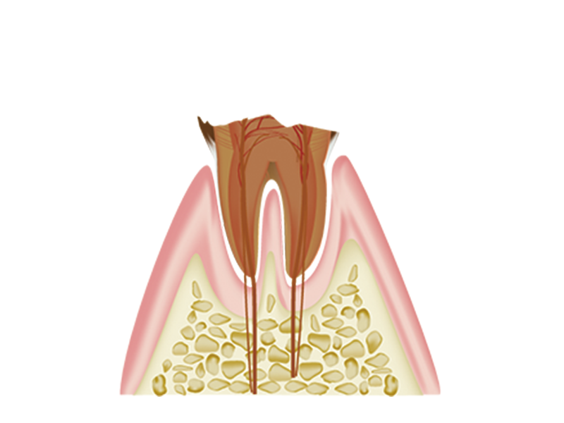歯質が失われた虫歯