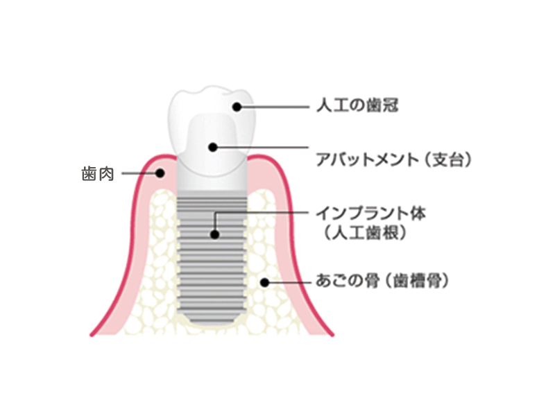 インプラントの構造