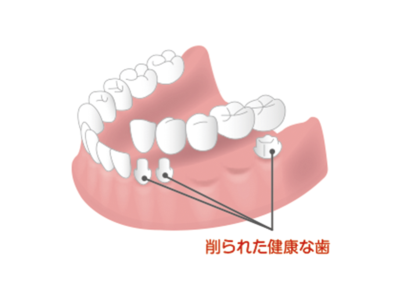 ブリッジ