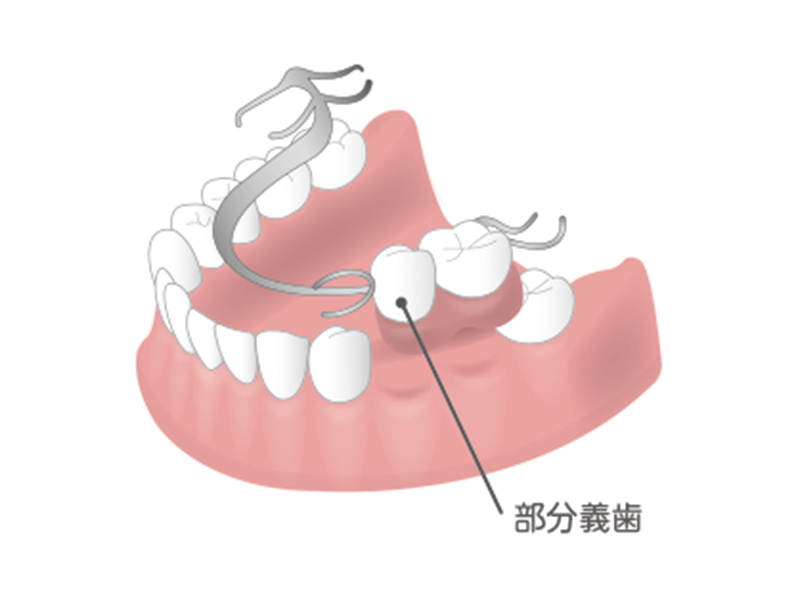 義歯(入れ歯)