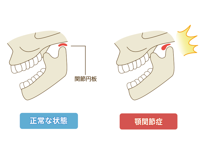 顎関節症の様子