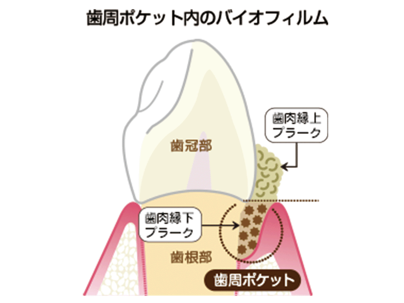 歯周ポケットのバイオフィル
