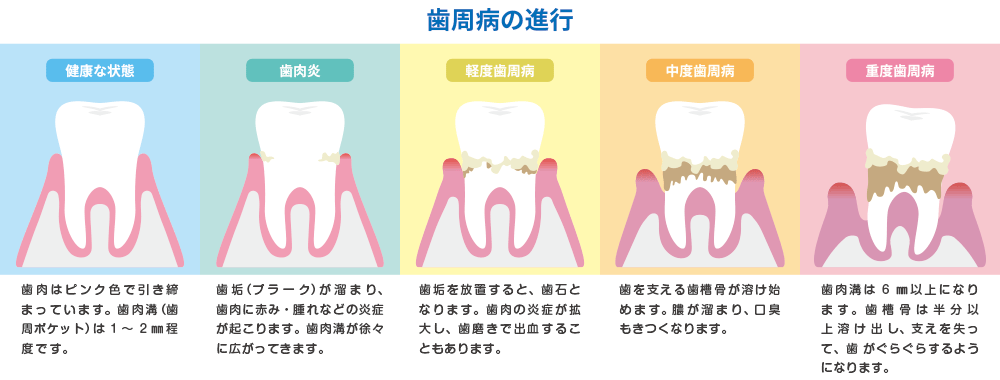 歯周病の進行
