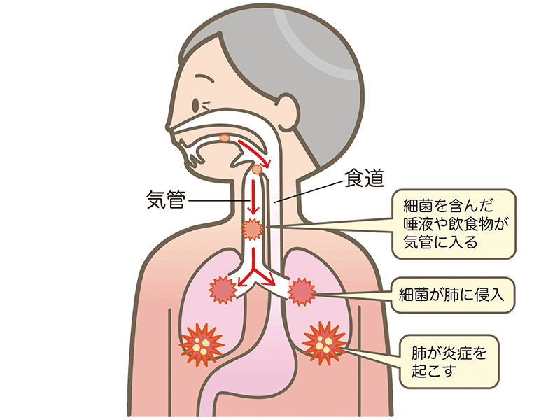誤嚥性肺炎
