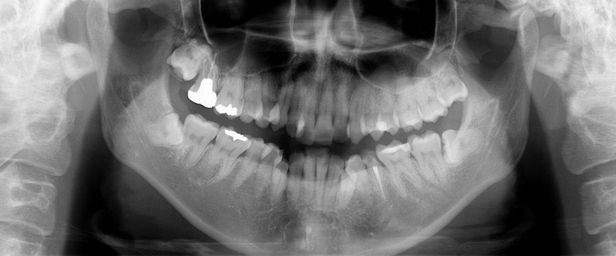 レントゲン写真